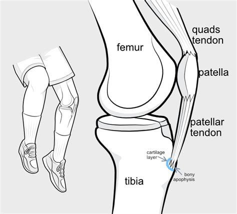 Tibial Tubercle Ossicle