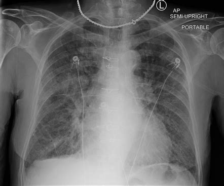 Transfusion-associated circulatory overload | Radiology Case ...