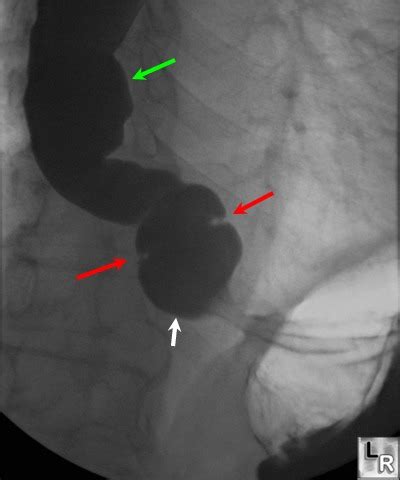 13+ Schatzki's Ring Of Distal Esophagus