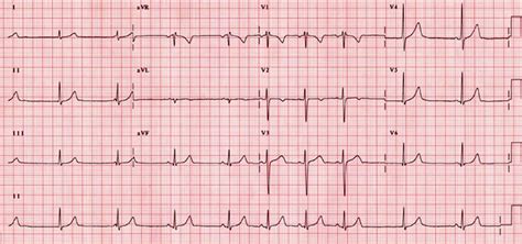 Sick Sinus Syndrome - Causes, Symptoms, ECG, Treatment