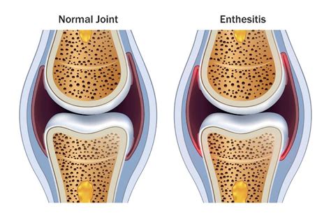 Enthesopathy and Enthesitis | Psoriatic arthritis, Ankylosing spondylitis, Psoriatic