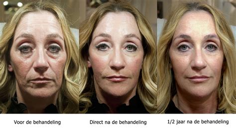 Pin by Karen Winslow on Liquid facelift met hyaluronzuur | Liquid facelift, Cosmetic surgery ...