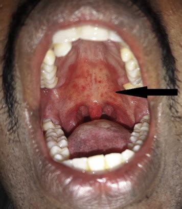 Erythematous Candidiasis - The Journal of Allergy and Clinical Immunology: In Practice