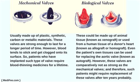 Surgery for Replacement of Aortic Valve: Risks and FAQs