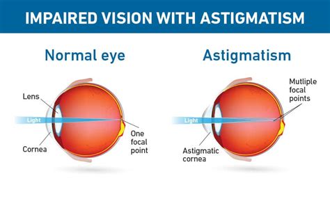 Cataract Surgery Venice | Toric IOL Sarasota | Cataracts Florida