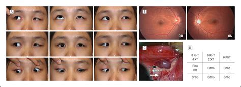 Anterior and Nasal Transposition of the Inferior Oblique Muscle for Iatrogenic Superior Oblique ...