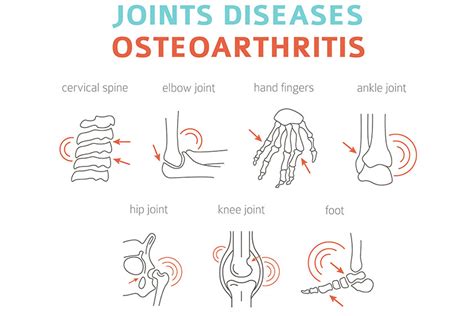 What Is Osteoarthritis? Learn The Different Stages | Morada Senior Living