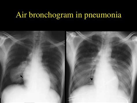 Chest X-ray: Alveolar vs Interstitial Disease | Epomedicine