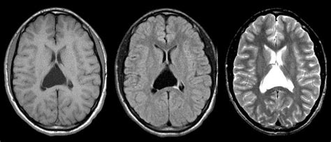 A 17 year-old girl underwent an MRI scan as part of a headache evaluation. Her neurological ...