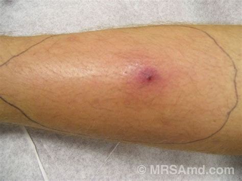 49 best Staph Infection images on Pinterest