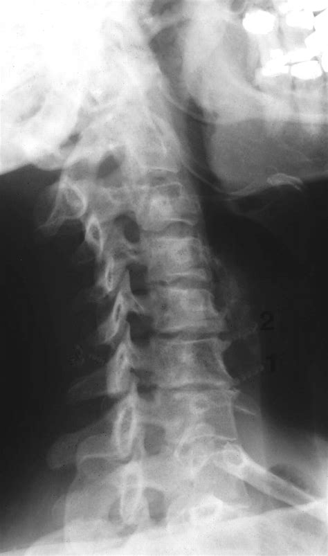 Cervical Spondylosis. Causes, symptoms, treatment Cervical Spondylosis