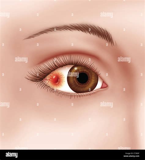 NODULAR SCLERITIS, DRAWING Stock Photo - Alamy