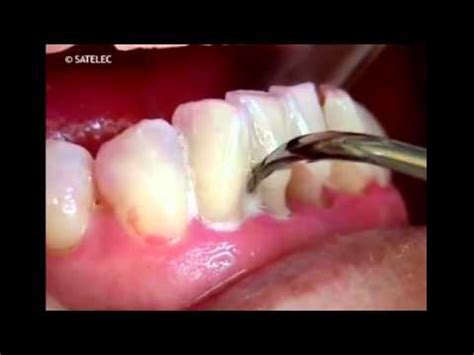 How Often Should Teeth Scaling Be Done - TeethWalls