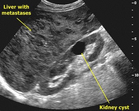 48 best images about Kidney Cyst on Pinterest | Cyst on kidney, Kidney disease and Dialysis