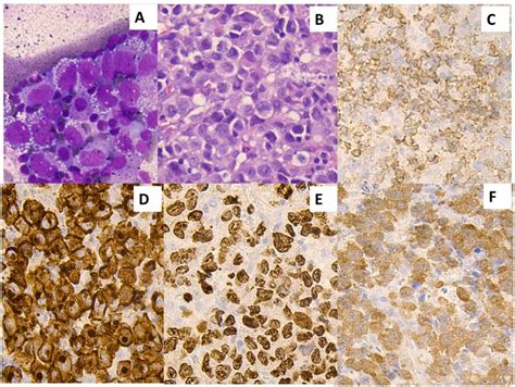 Anaplastic large-cell lymphoma histology numerous large tumor ...