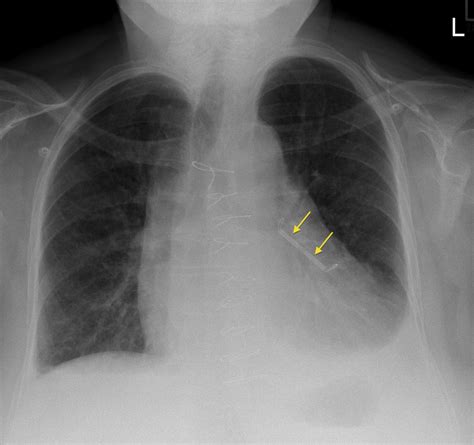 Atrial appendage closure device - Radiology at St. Vincent's University Hospital