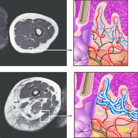 MRI cross-section of the distal femur of a similar patient, of the ...