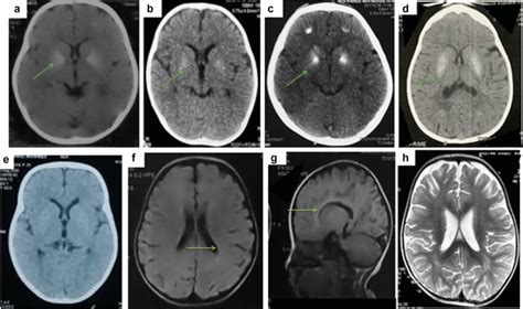 a–d Brain CT scans showing calcification in basal ganglia in the... | Download Scientific Diagram