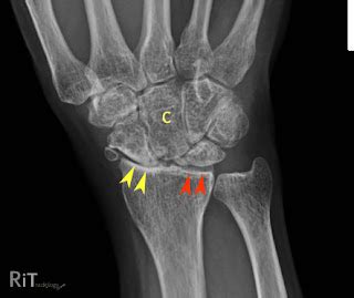 RiT radiology: Scapholunate Advanced Collapse (SLAC-wrist)