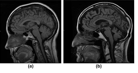 Figure 2 from Benign and malignant diseases of the clivus. | Semantic ...