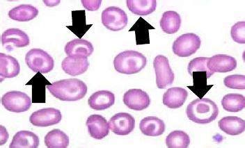 Codocytes known as Target Cells | Medical Laboratories