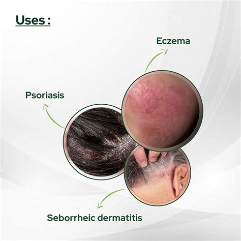 Psoriasis Coal Tar Salicylic Acid 50gm by SALVE