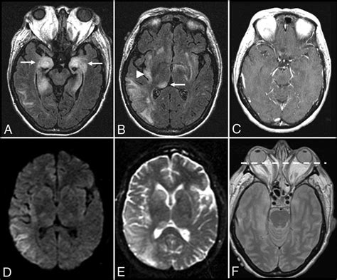 Autoimmune Encephalitis: Pathophysiology and Imaging Review of an Overlooked Diagnosis ...