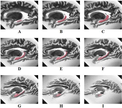 Figure 1 from Neuropathologic Correlates of Hippocampal Atrophy in the Elderly: A Clinical ...