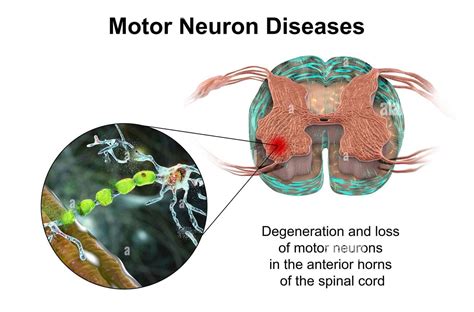 Motor Neuron Disease