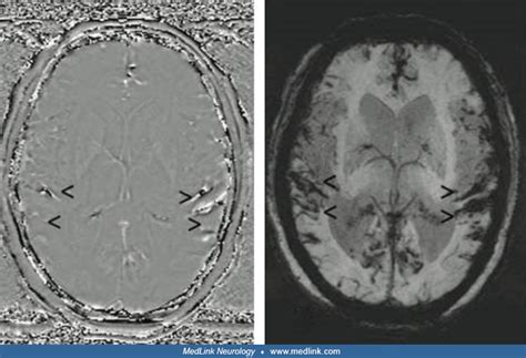 Superficial siderosis (MRI) | MedLink Neurology