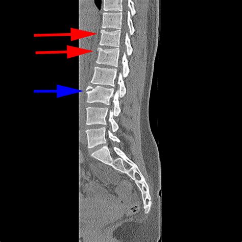 Limbus vertebra vs Fracture : 네이버 블로그