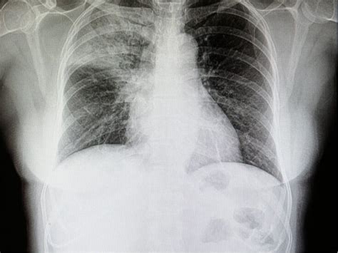 Lung cancer X-rays fail to detect almost a quarter of cases