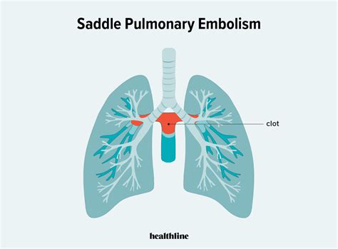 Saddle Pulmonary Embolism Diagram