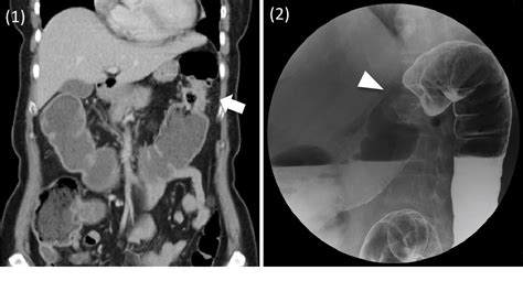 Figure 1 from Apple-core Lesion of Colon Adenocarcinoma by Barium Double Contrast Enema ...