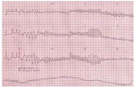 Ventricular Fibrillation – Hope For Hearts