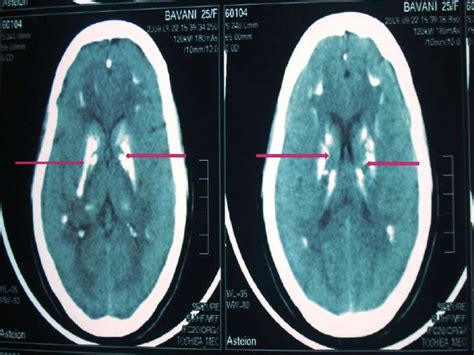 CT: Basal Ganglia Calcification