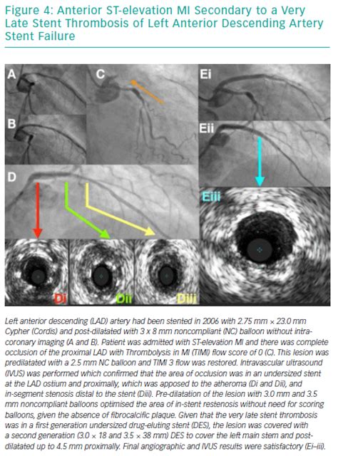 Contemporary Management of Stent Failure: Part One | ICR Journal