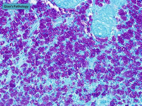 Qiao's Pathology: Disseminated Mycobacterium avium intracellulare complex (MAC) in Jejunum - a ...