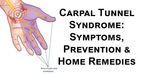 Carpal tunnel syndrome symptoms - lanvol