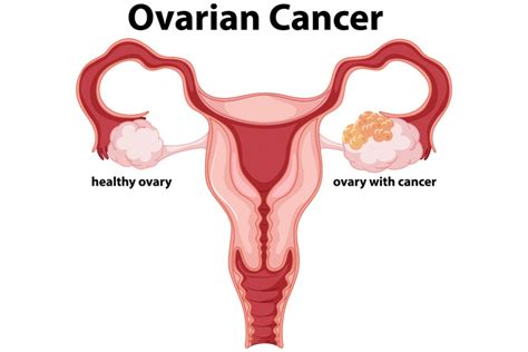 Screening Ovarian Cancer – Lifeline Laboratory