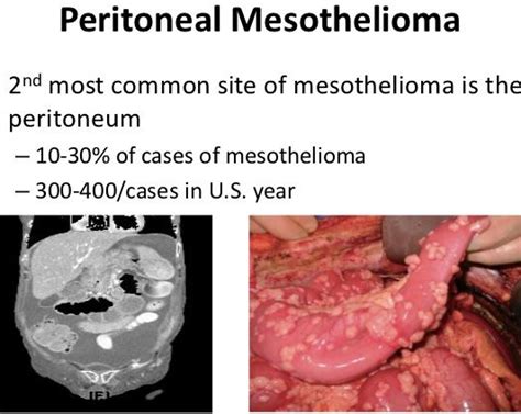 peritoneal mesothelioma - wikitechy