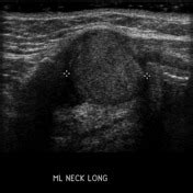 Thyroglossal Duct Cyst Ultrasound