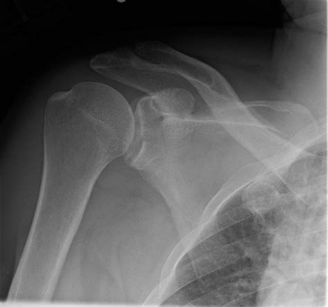 Scapula Fractures - Trauma - Orthobullets