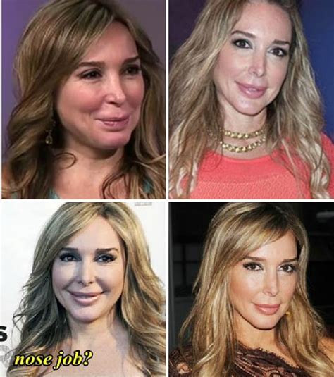 Marysol Patton Before and After Plastic Surgery