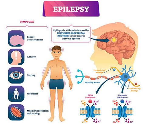 Symptoms of epilepsy - MEDizzy