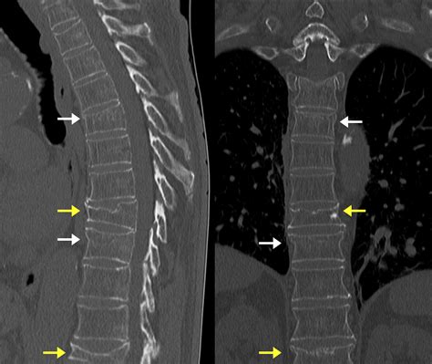 Vertebral Body Compression Fracture Image Radiopaedia Org | My XXX Hot Girl