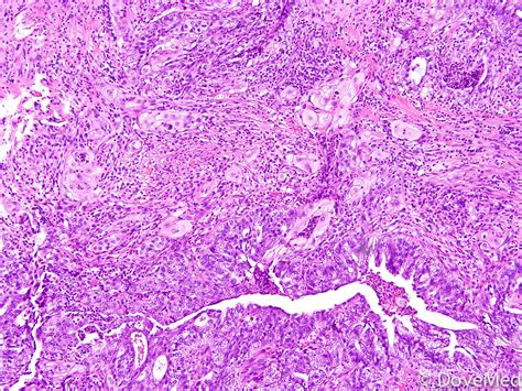 Adenosquamous Carcinoma of Uterine Cervix