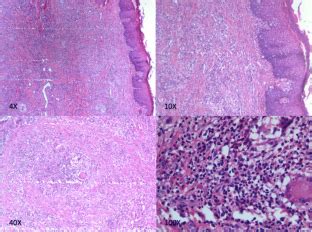 A severe case of cheilitis granulomatosa: clinical-pathologic findings and management | SpringerLink