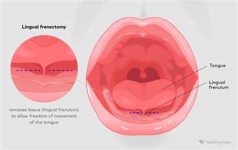 Frenectomy: Definition, Reasons, Recovery