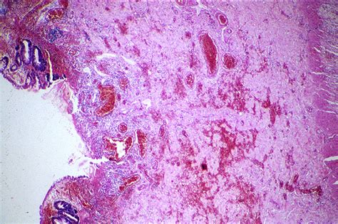 Duke Pathology - Gastrointestinal Tract